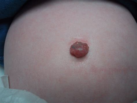 Belly Button Discharge Causes Yeast Smelly White