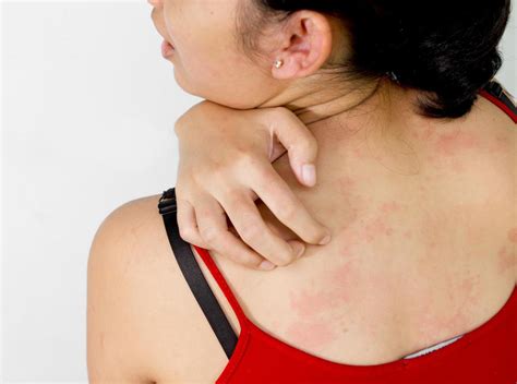 types  viral infection rash