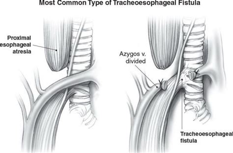 Tracheoesophageal Fistula Repair