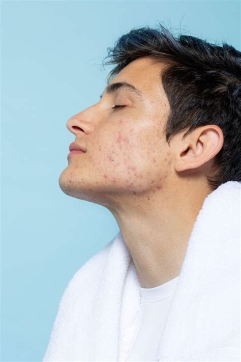 pimple treatment   treat acne  pimple prevention