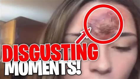 majorly disgusting pimple popping moments from 2021 part 2 youtube