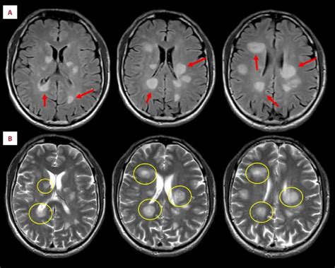 pre treatment brain magnetic resonance imaging mri