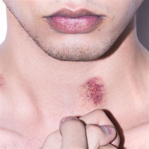 how to get rid of a hickey if you somehow are still getting hickeys