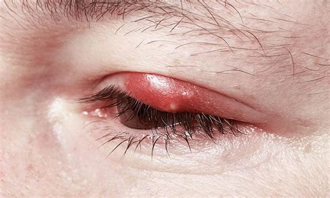 swollen sore eyelid     problem atlanta vision cataract  laser center