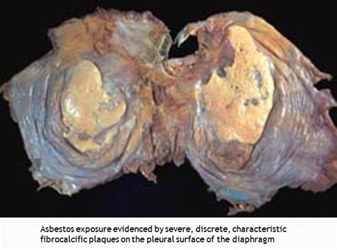 Asbestosis Pleura Asbestos Related Lung And Pleural Disease