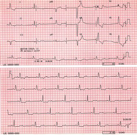 case   degree av block   block st emlyns ecg library