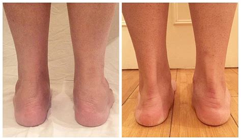 New Technique Promises To Banish Chunky Ankles In 15 Minutes Daily