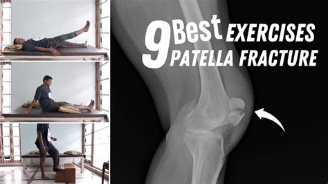 Fracture Patella Broken Knee