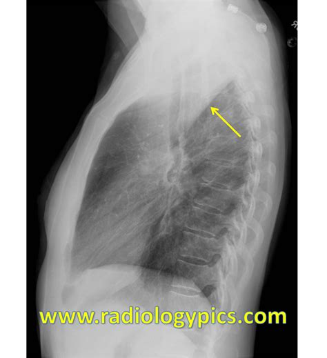 The Golden S Sign – Right Upper Lobe Collapse Radiologypics Com