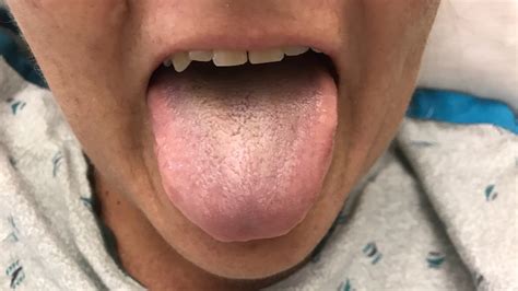 Black Hairy Tongue What Is It And How Do You Get It