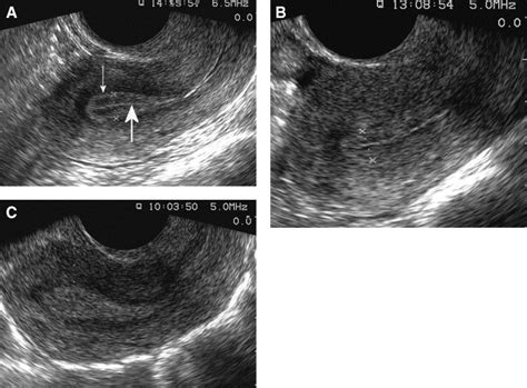 Ultrasound Characteristics And Histological Dating Of The Endometrium