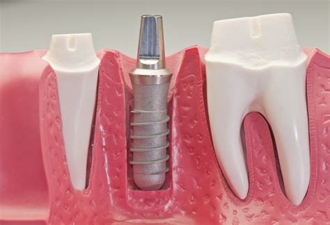 dental implants virginia family dentistry