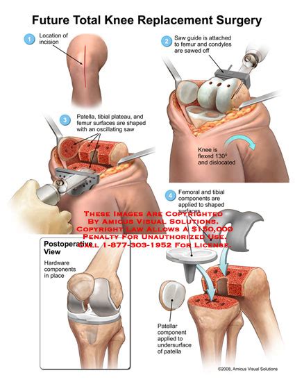 Future Total Knee Replacement Surgery