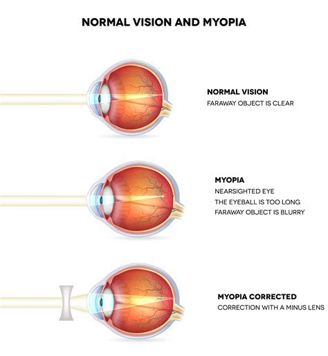 myopic macular degeneration  develop  people   severe
