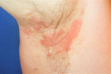 Seborrheic Dermatitis Symptoms Complications And More