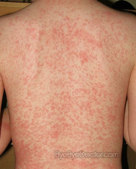 fungal rash causes symptoms causes treatment and prevention of diseases