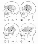 Temporomandibular Disorders Assessment Somatic Elsevier Mapping Headaches Bruxism Masseter sketch template