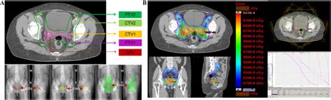 intensity modulated radiotherapy combined with iodine 125 seed