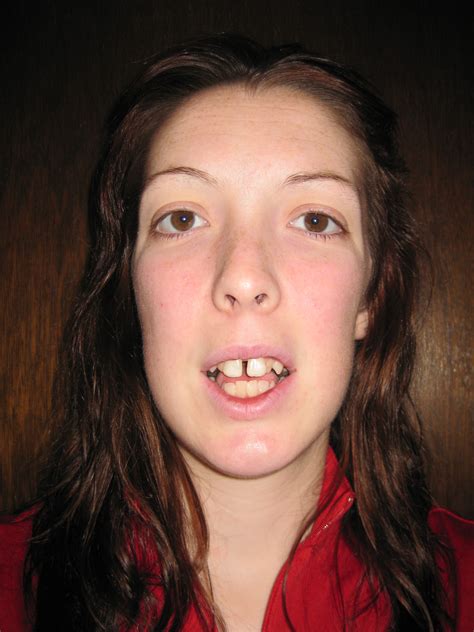 Mskirby Sarpe Facial And Braces Pics