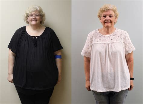 Debra S Weight Loss Transformation St Louis Bariatrics