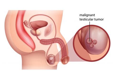 Testicular Cancer Signs Symptoms And Treatment Options