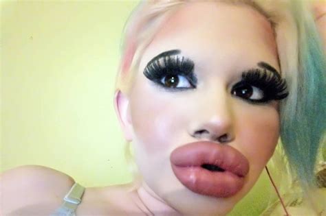 woman who wants ‘biggest lips in the world has 15 procedures to be