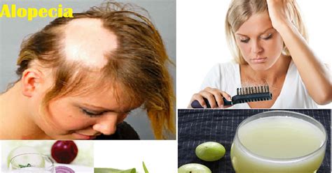 Alopecia Alopecia Natural Treatment