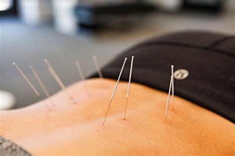 dry needling impact physical therapy