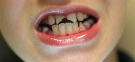 dental procedures  repair  broken tooth