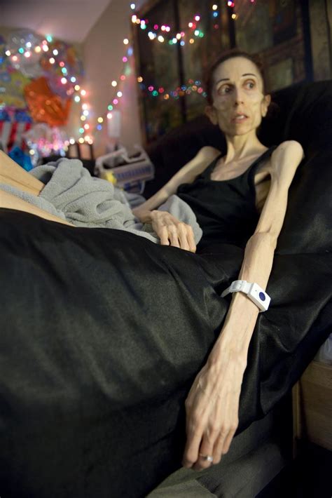 ‘it’s Hell’ San Clemente Woman’s Video Shines Light On Adult Anorexia
