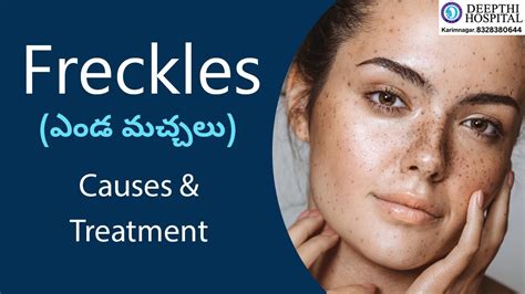 Freckles Causes And Treatment Dr Deepthi Prasad Dermatologist