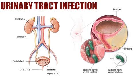 Urinary Tract Infection Causes Symptoms Diagnosis