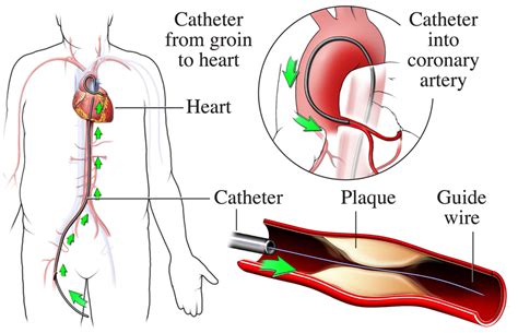 cardiac catheterization during cardiac catheterization nhlbi nih