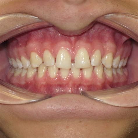 spacing  teeth orthodontist ottawa  centrepointe orthodontics