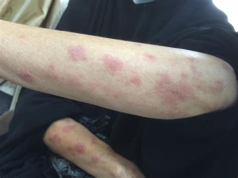 Cureus Adalimumab Induced Erythema Multiforme In A Patient With