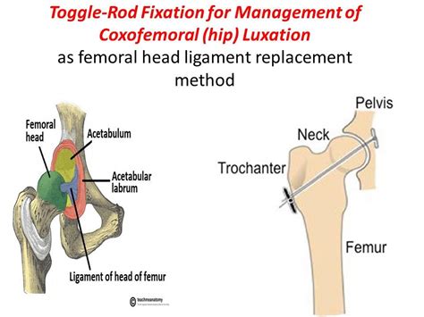 toggle rod fixation  management  coxofemoral hip luxation youtube
