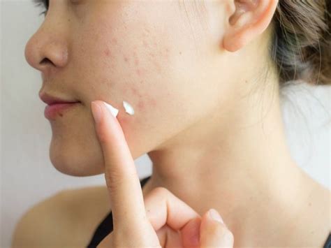 pimple  skin  home remedies    health tips