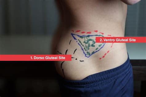 How To Do Ventrogluteal Injection Glute Injection Guide And Demo
