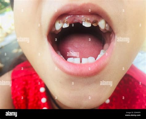 girl  open mouth showing  teeth  checking  cavity