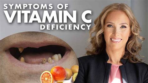 Vitamin C Deficiency Symptoms Causes Treatment And Prevention