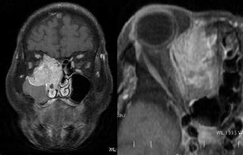 maxillary sinus neoplasms cancer  maxillary sinus