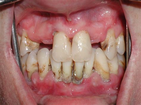diseases periodontal disease