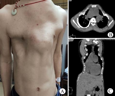 thorax appearance  operation     ct scan