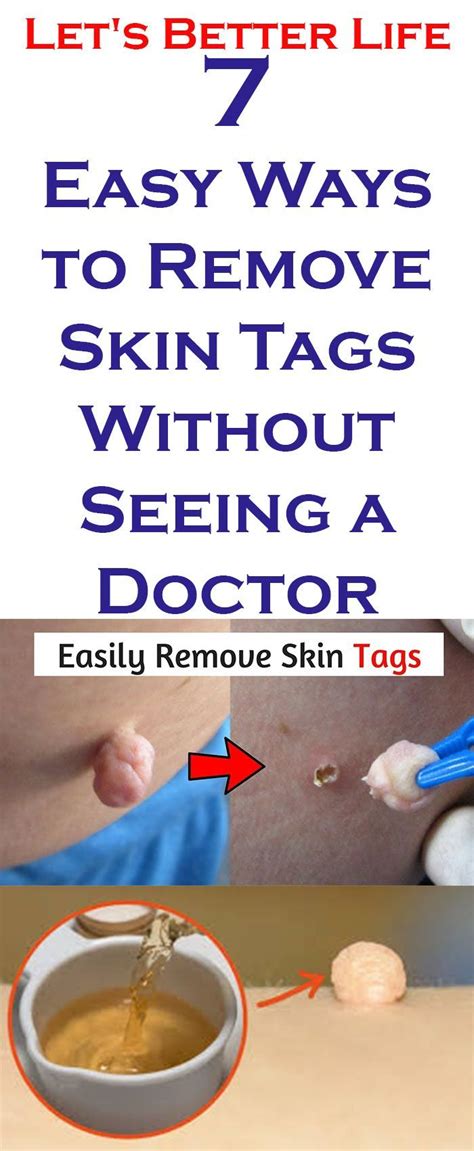 7 easy ways to remove skin tags without seeing a doctor skin tag