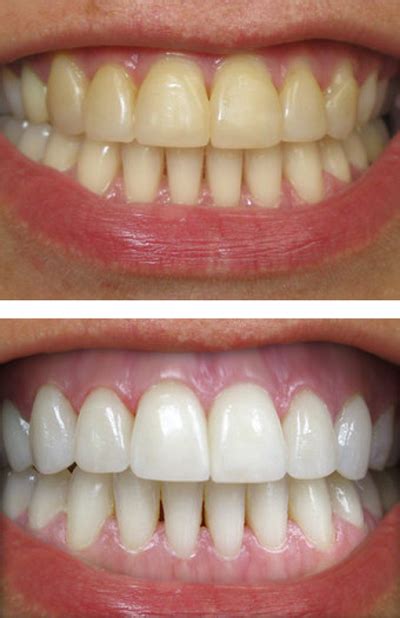 tooth whitening services newmarket family dental care