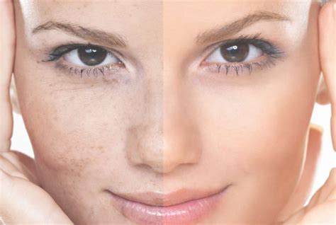 skin pigmentation treatments   options secrets  beauty