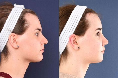 facial feminization surgery lipofilling feminizing the face with