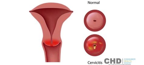 bacterial vaginosis causes symptoms diagnosis and treatment