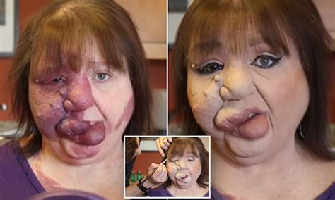 youtube video shows how mom uses make up to hide port wine