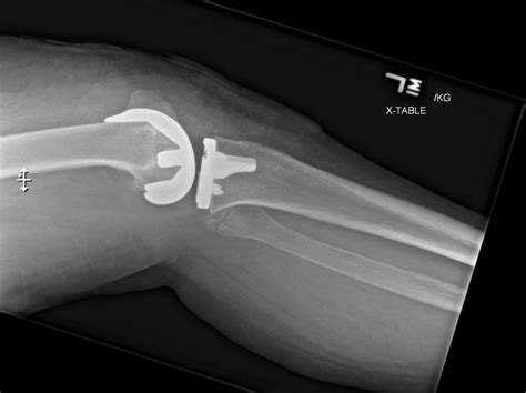 Ortho Dx A Fall Following Total Knee Replacement